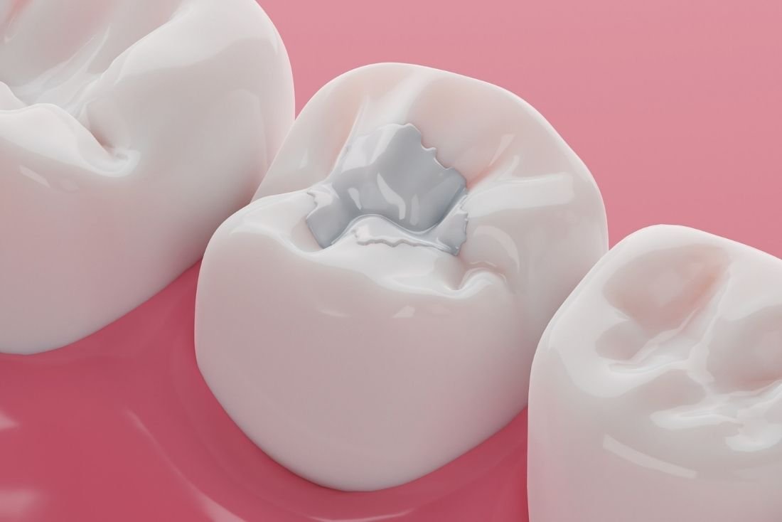 Composite Fillings Image