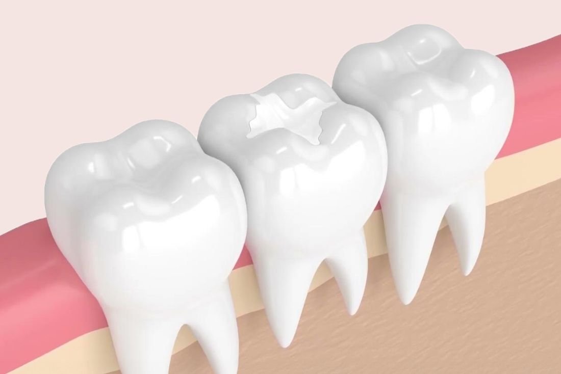 Sealants Image